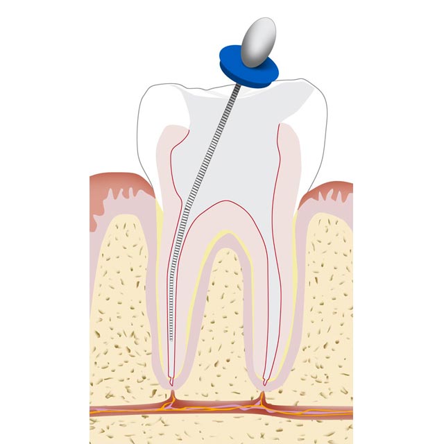 wurzelkanalbehandlung-endodontie